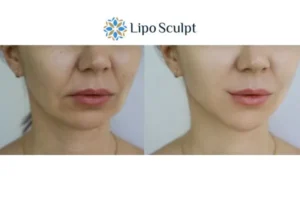 Explaining Total Skin Tightening Treatment And What It Can Do For You 2 Do you want to boost your self confidence? Give Morpheus8 Seacombe a try today!