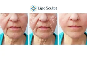 Explaining Total Skin Tightening Treatment And What It Can Do For You 3 Boost your confidence with Morpheus8 Seacombe call our team today!