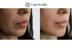 Explaining Total Skin Tightening Treatment And What It Can Do For You 4 Morpheus8 Seacombe the best results - call our team today!