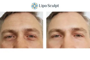 Explaining Total Skin Tightening Treatment And What It Can Do For You 6 Morpheus8 Seacombe book in today to find out more!