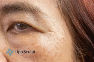 Cryopen: The Revolutionary Treatment for Age Spots Unveiled 2 Are age spots Seacombe giving you low self esteem? Contact us today!