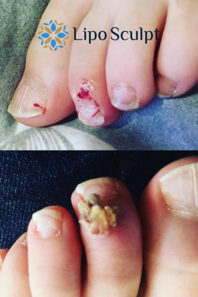 Wart removal customer results from Lipo Sculpt Seacombe